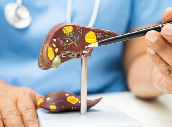 Gordura no Fígado Tem Cirurgia? Separando a Ciência do Sensacionalismo na Esteatose Hepática